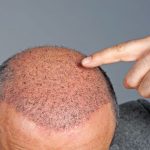Alopécie : causes et préventions